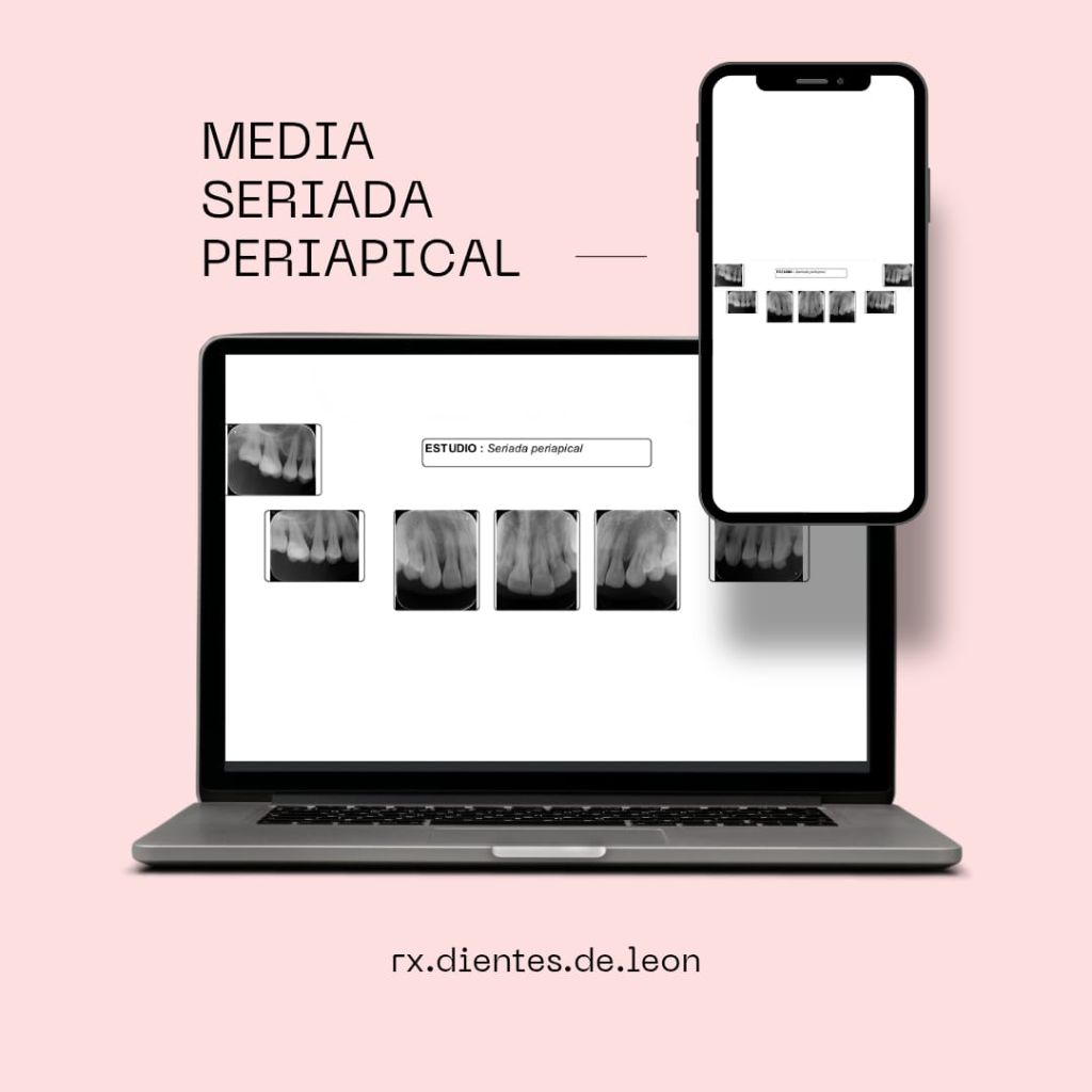 Media Seriadas Periapical