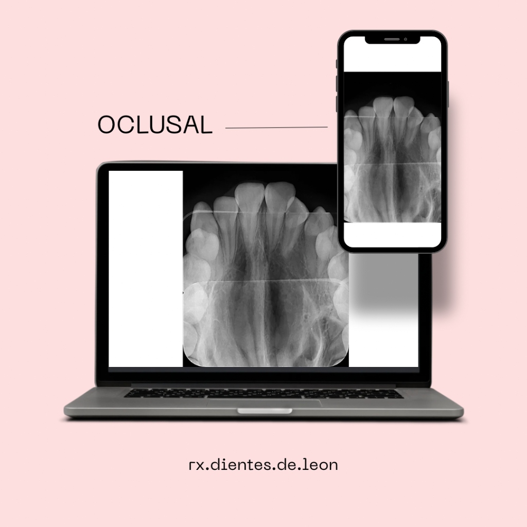 Radiografía Oclusal