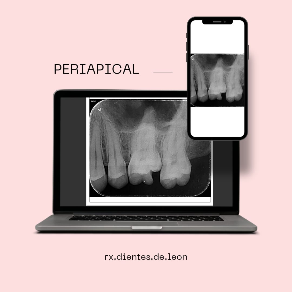 Radiografía Periapical